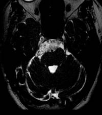 cerebelloponineangleepidermoidcyst.jpg