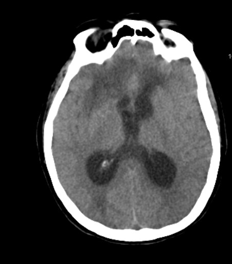 contusioncerebralbifrontal.jpg