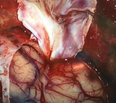 craneotomiafrontotemporalaperturadural.jpg