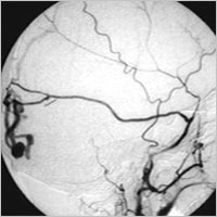 fistulaarteriovenosadural.jpg