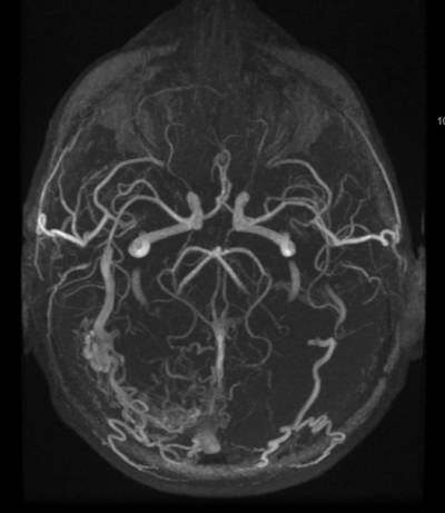 fistulaarteriovenosaduralresonancia7257.jpg
