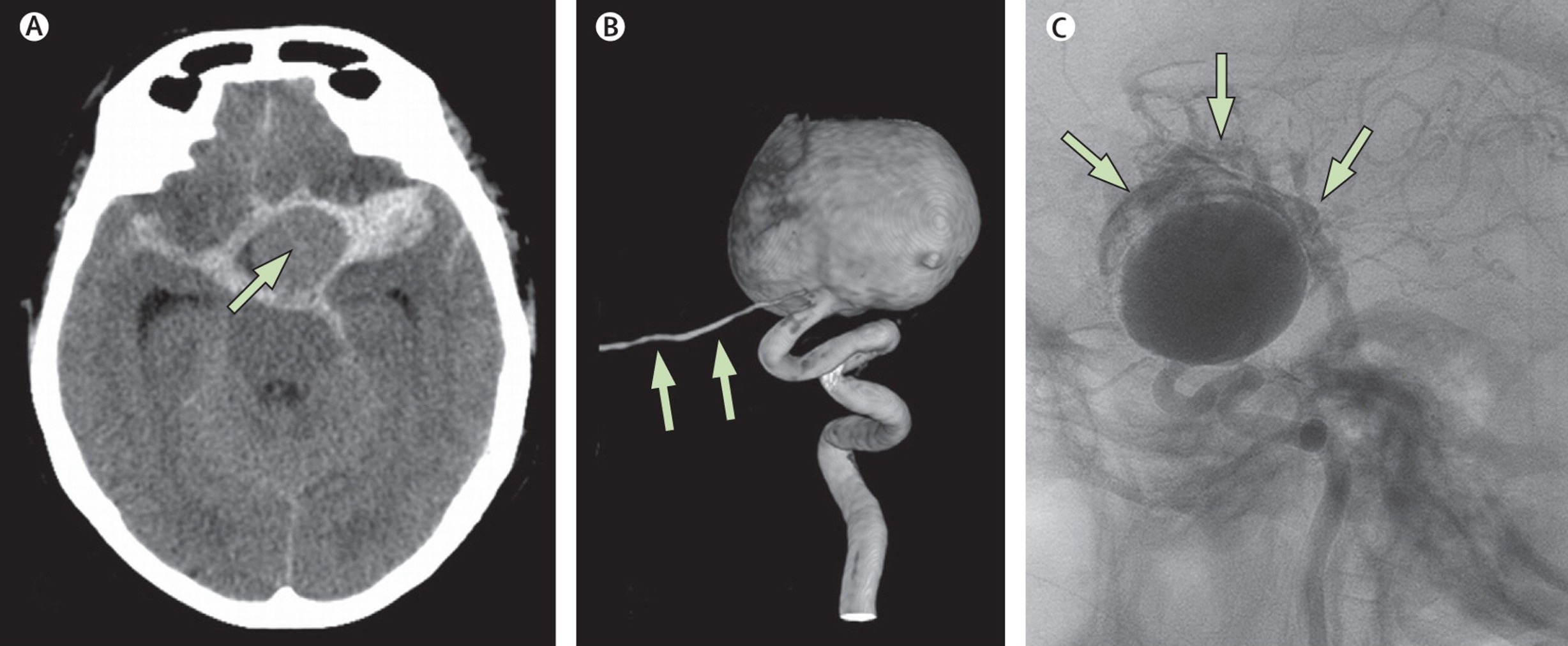 giantophtalmicarteryaneurysm.jpg