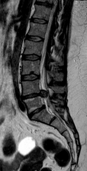 herniadiscallumbarl4l5grande.jpg
