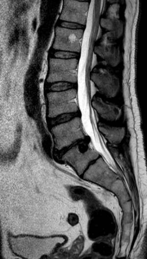 herniadiscallumbarl5s1q5483.jpg