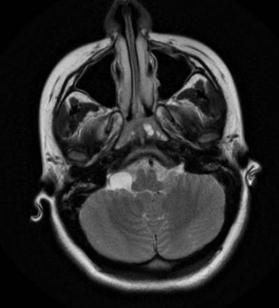 quistearacnoideodeangulopontocerebelosoq5482.jpg