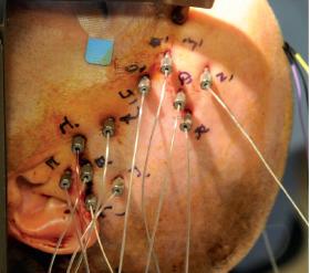 stereoelectroencephalography.jpg