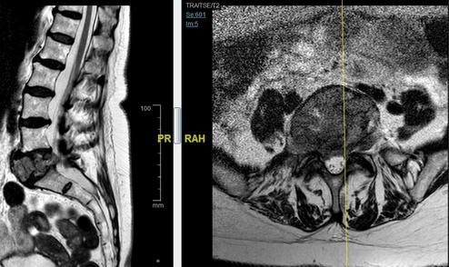 tumorespinalvertebrallumbari7352.jpg
